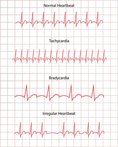 Types of Abnormal Heart Rhythms