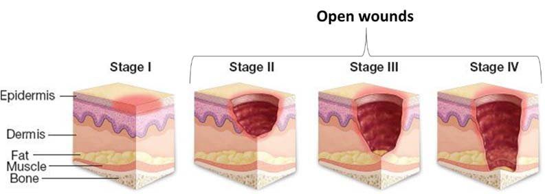 Stages of Pressure Injuries