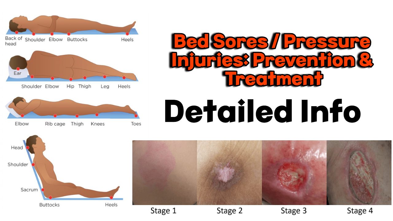 Pressure Ulcers (Bedsores): Symptoms, Staging, and Optimal Care Strategies