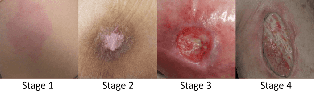 Stages of Pressure Injuries